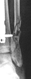 fibula shards