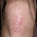 Post-staple knee